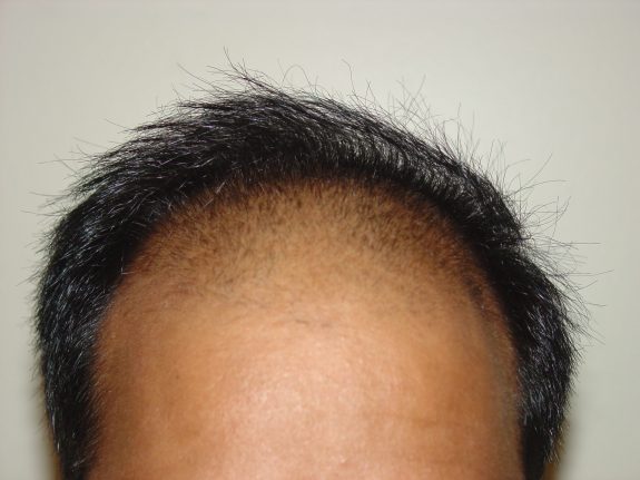 Hair Restoration Example - Before 39