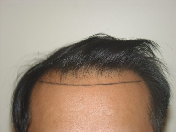 Hair Restoration Example - Before 40