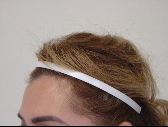 Hair Restoration Example - After 3 2