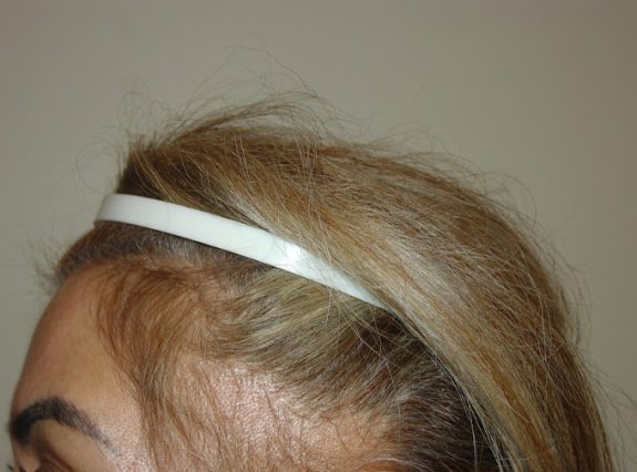 hair-restoration-03-Before