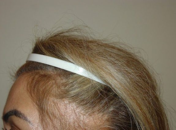 Hair Restoration Example - Before 3 2